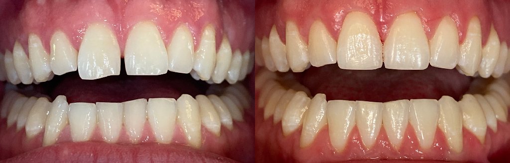 Close up photos of teeth before and after Invisalign in Schoharie