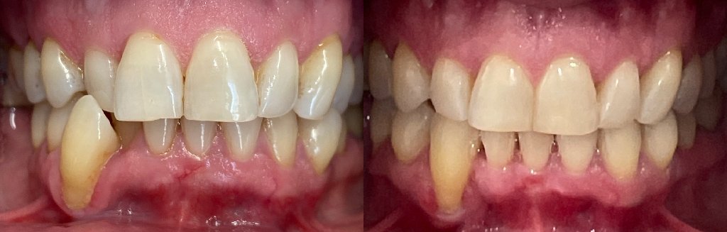 Close up photos of teeth before and after Invisalign in Schoharie