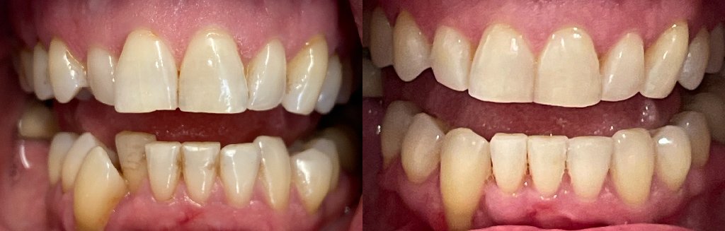 Close up photos of teeth before and after Invisalign in Schoharie