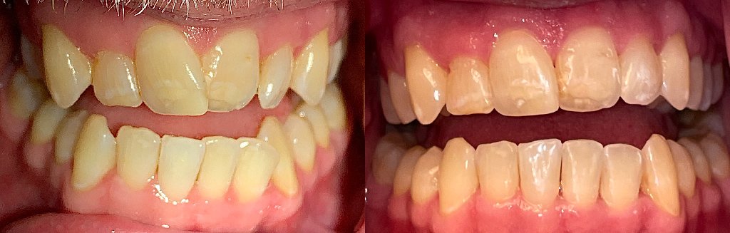 Close up photos of teeth before and after Invisalign in Schoharie