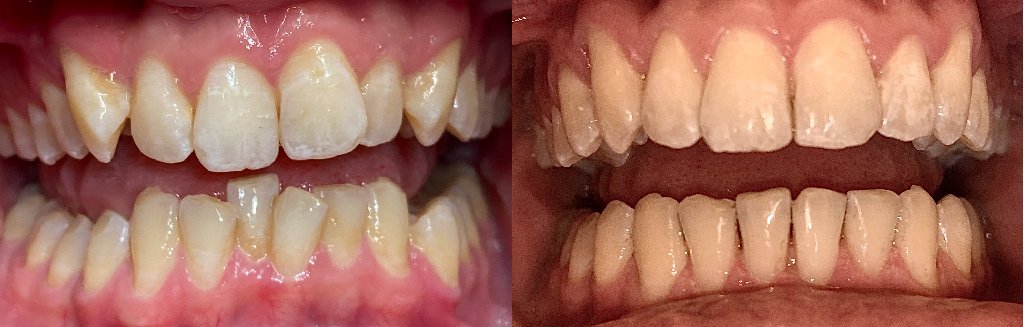 Close up photos of teeth before and after Invisalign in Schoharie