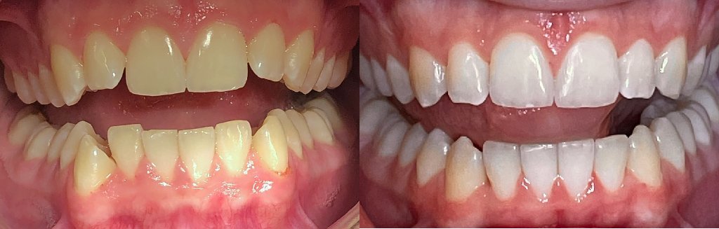 Close up photos of teeth before and after Invisalign in Schoharie