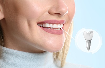 patient smiling with dental implant in mouth