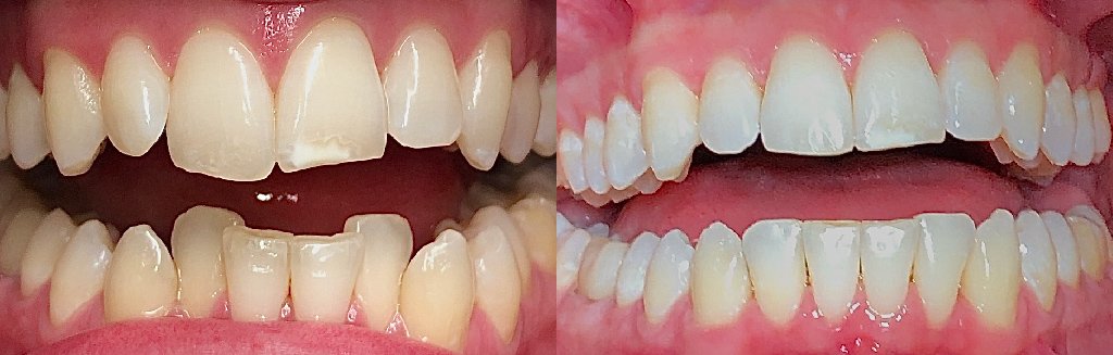 Close up photos of teeth before and after Invisalign in Schoharie