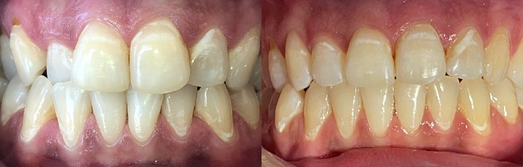 Close up photos of teeth before and after Invisalign in Schoharie