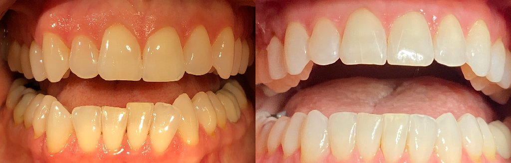 Close up photos of teeth before and after Invisalign in Schoharie