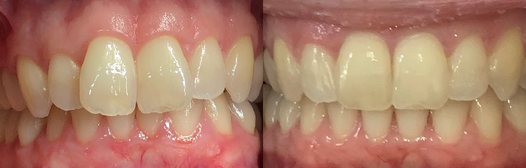 Close up photos of teeth before and after Invisalign in Schoharie