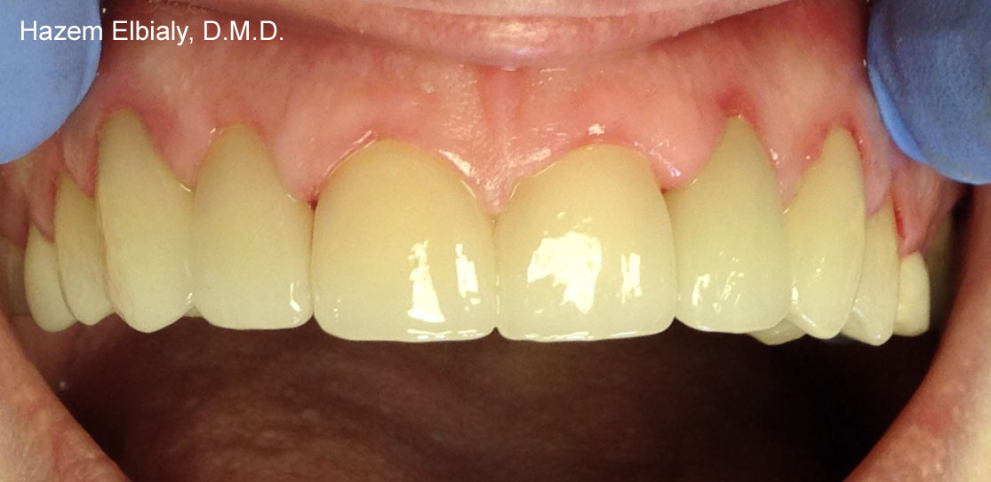 Close up of flawless teeth after ceramic dental crowns