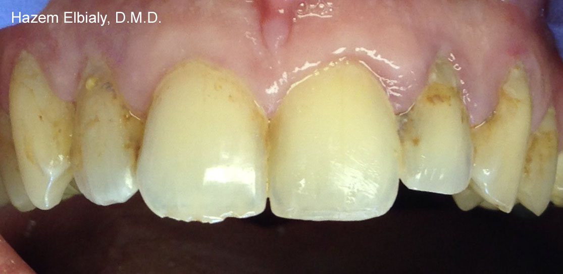 Close up of imperfect teeth before ceramic dental crowns