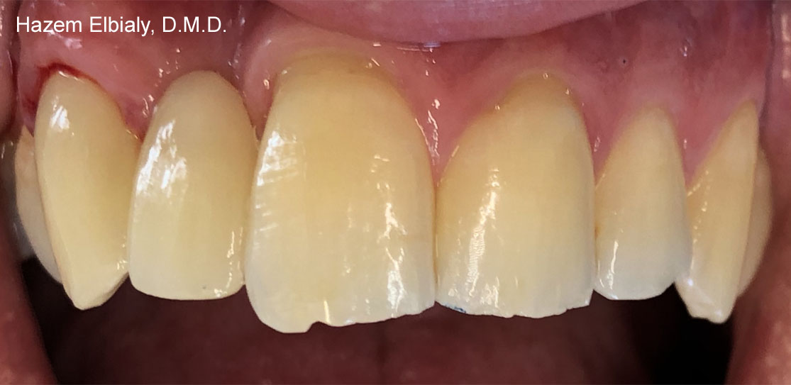 Close up of flawless teeth after ceramic dental crowns