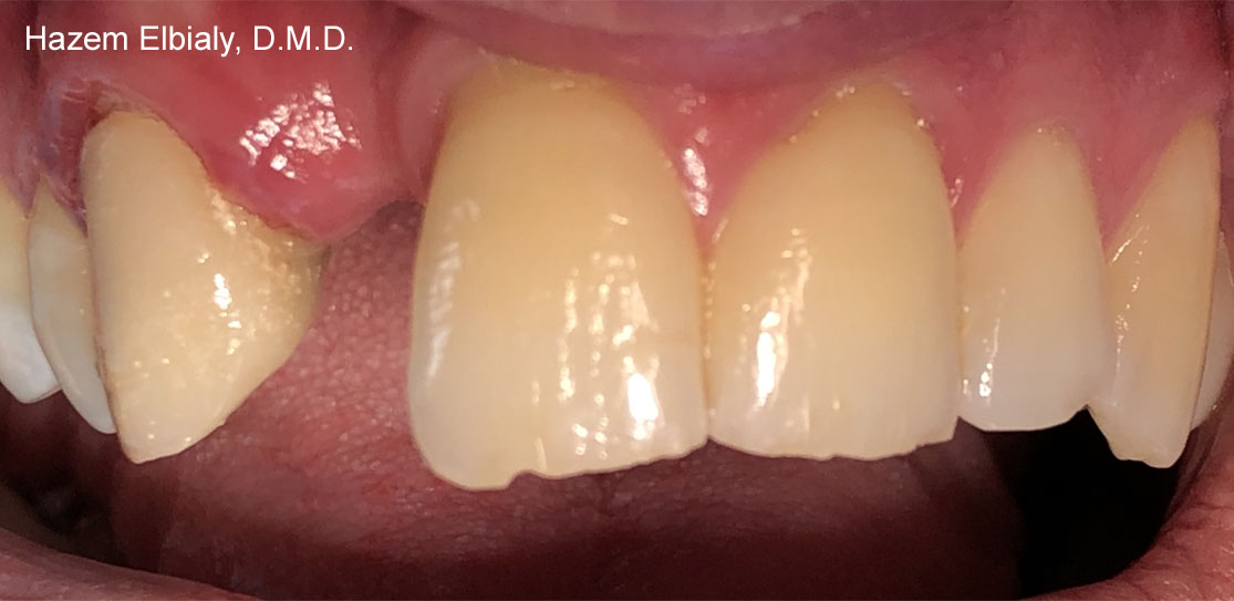 Close up of imperfect teeth before ceramic dental crowns