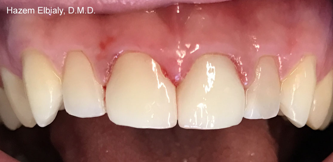 Close up of flawless teeth after ceramic dental crowns