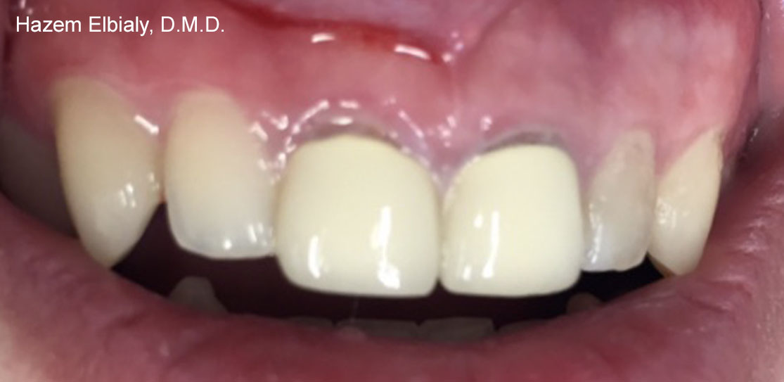 Close up of imperfect teeth before ceramic dental crowns