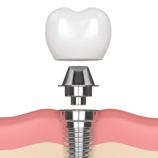 Animated dental implant with abutment and crown being placed in the jaw