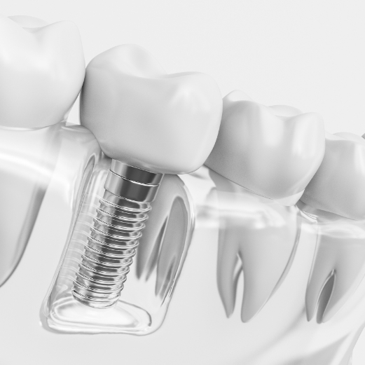 Animated dental implant in the lower jaw