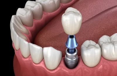 Animated dental implant with dental crown