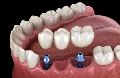 Two animated dental implants with dental bridge