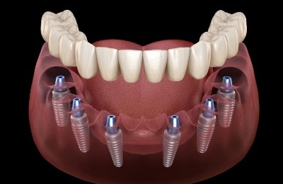 Animated implant denture supported by six dental implants