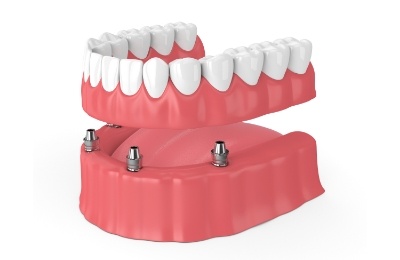 Animated full implant denture supported by four dental implants