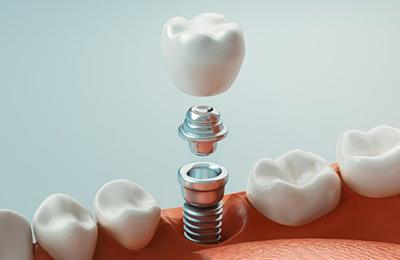 a 3 D illustration of the parts of dental implants