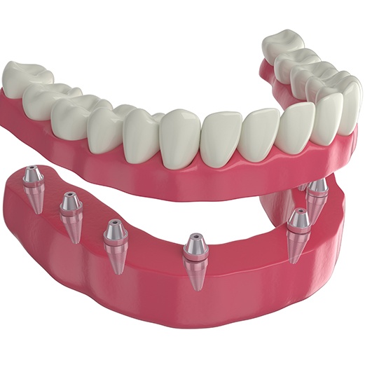 Digital rendering of implant denture
