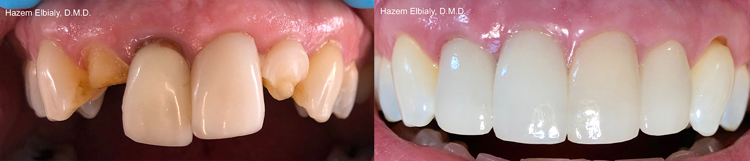 Close up of smile before and after replacing damaged and missing teeth with dental implants