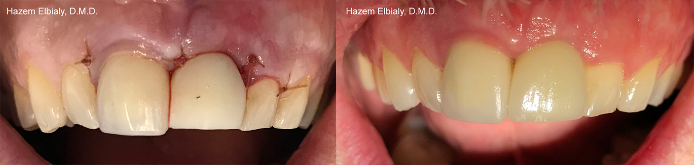 Close up of smile before and after replacing damaged and missing teeth with dental implants