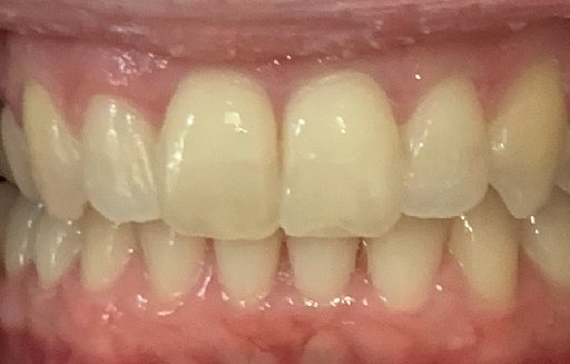 Close up of straighter teeth after Invisalign