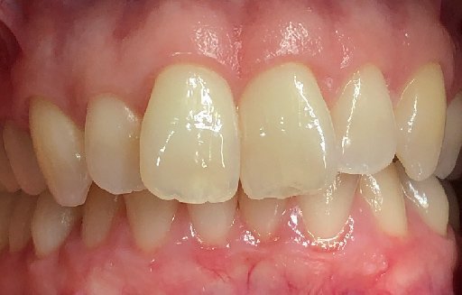 Close up of misaligned teeth before Invisalign