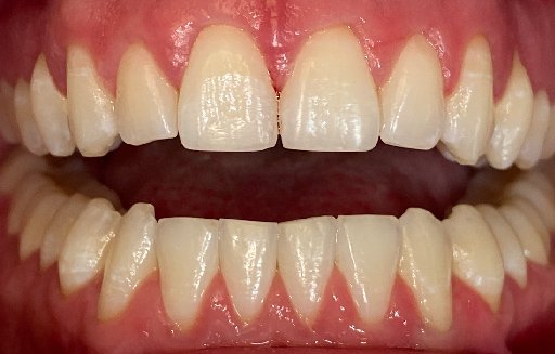 Close up of straighter teeth after Invisalign