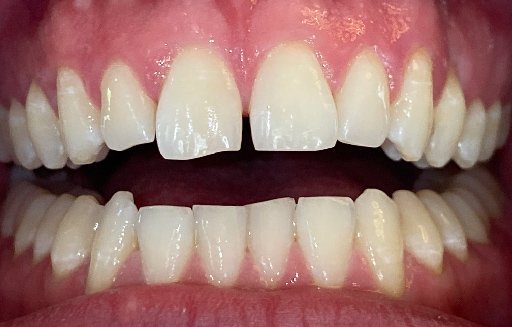 Close up of misaligned teeth before Invisalign