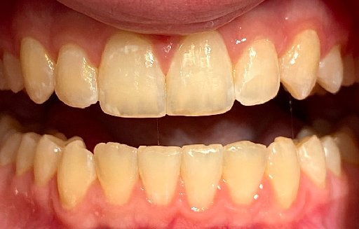 Close up of straighter teeth after Invisalign