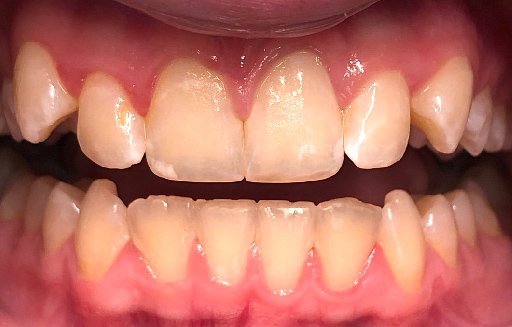 Close up of misaligned teeth before Invisalign