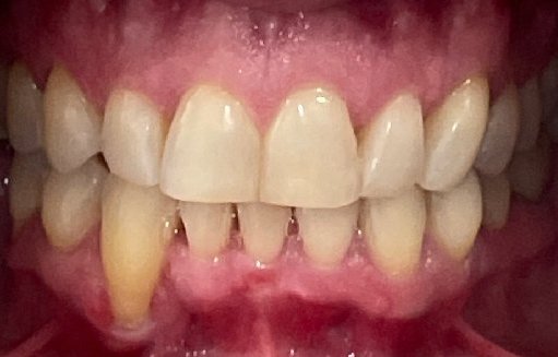 Close up of straighter teeth after Invisalign