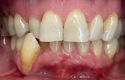 Close up of misaligned teeth before Invisalign