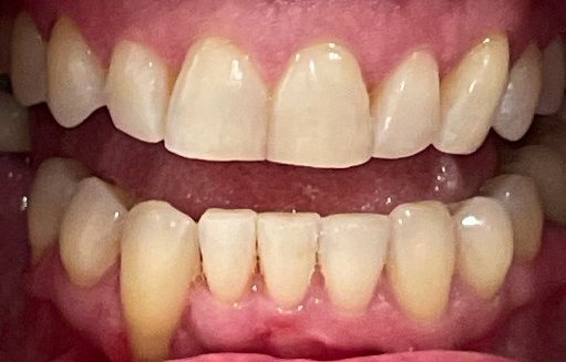 Close up of straighter teeth after Invisalign