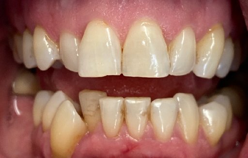 Close up of misaligned teeth before Invisalign