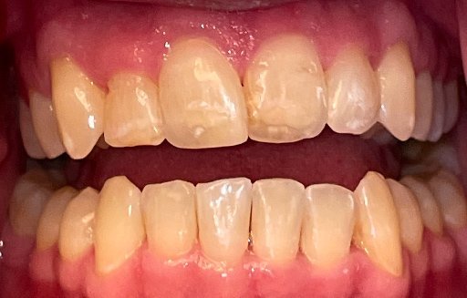 Close up of straighter teeth after Invisalign