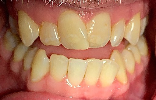 Close up of misaligned teeth before Invisalign