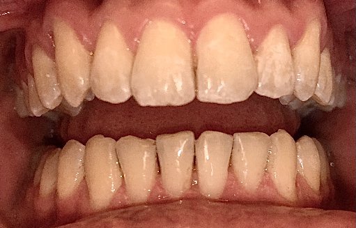 Close up of straighter teeth after Invisalign