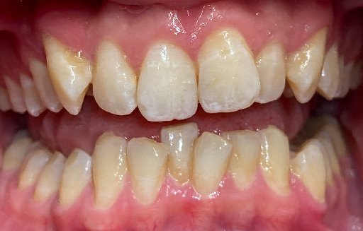 Close up of misaligned teeth before Invisalign