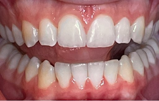 Close up of straighter teeth after Invisalign