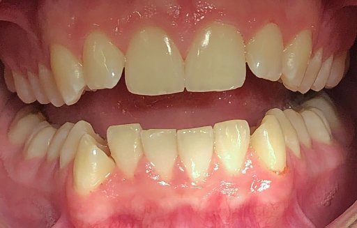 Close up of misaligned teeth before Invisalign