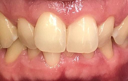 Close up of misaligned teeth before Invisalign