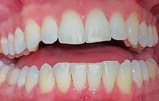 Close up of straighter teeth after Invisalign