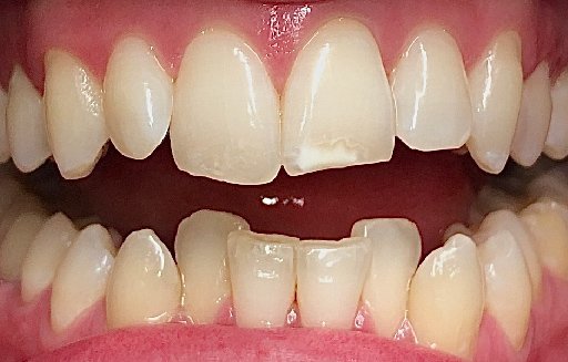 Close up of misaligned teeth before Invisalign