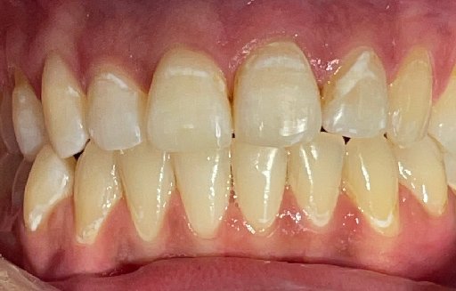 Close up of straighter teeth after Invisalign