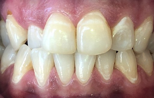 Close up of misaligned teeth before Invisalign