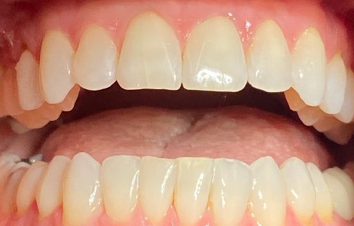 Close up of straighter teeth after Invisalign