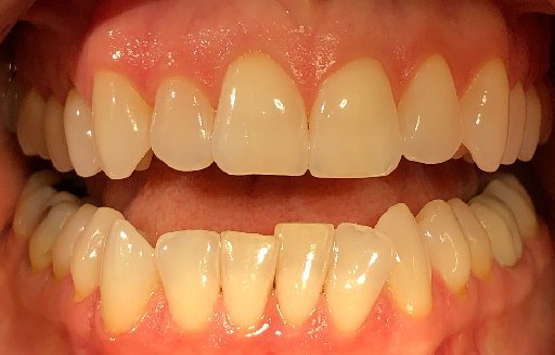 Close up of misaligned teeth before Invisalign